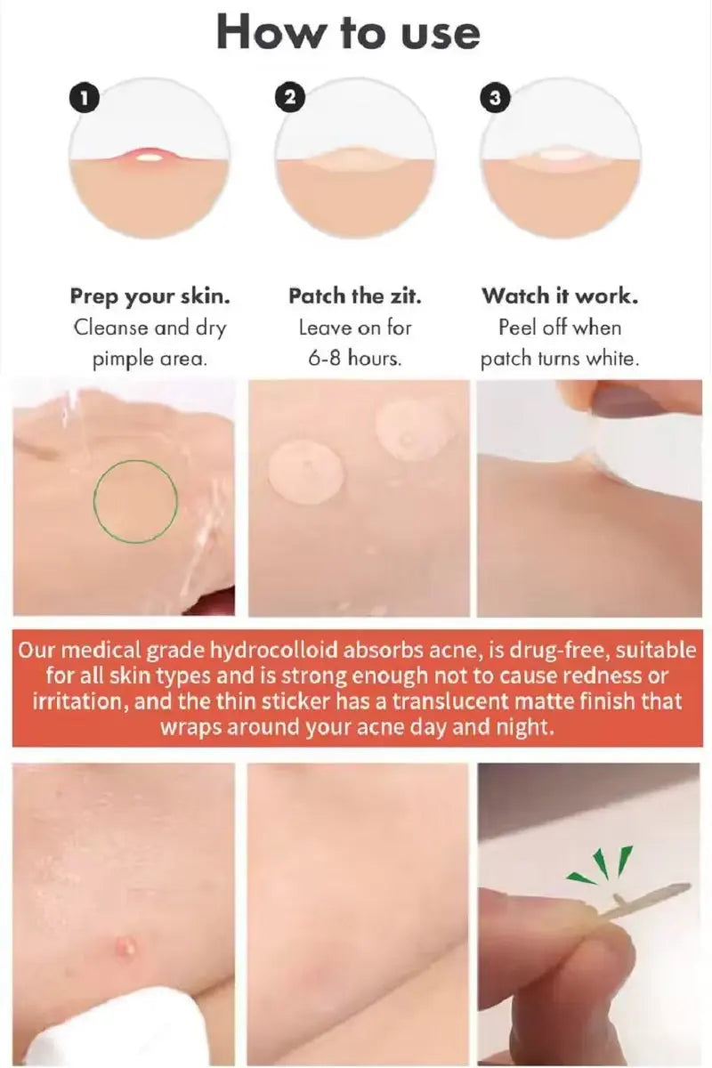 The Original Hydrocolloid Acne Pimple Patch - Nighttime Blemish Spot Treatment Zenana